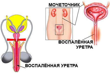 Urethritis: causes, symptoms and treatment