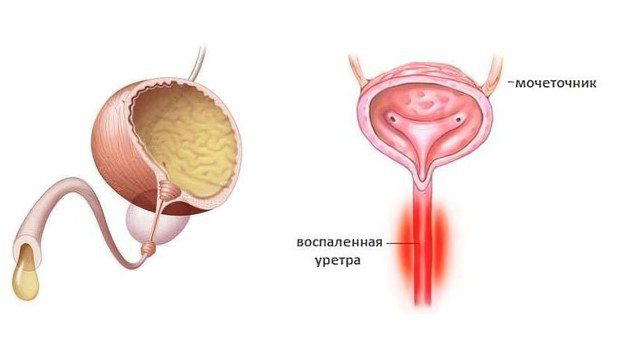 Urethritis: causes, symptoms and treatment