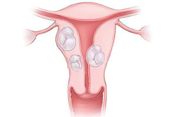 Uterine fibroma, vaginal fibroma