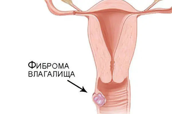 Uterine fibroma, vaginal fibroma