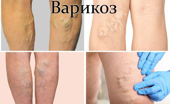 Varicose veins: causes, symptoms, treatment