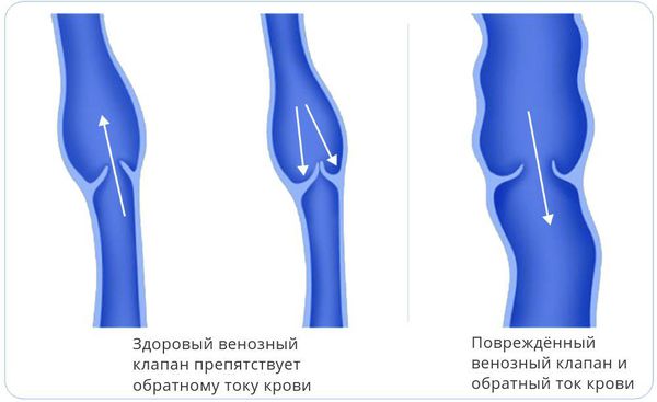 Varicose veins: causes, symptoms, treatment