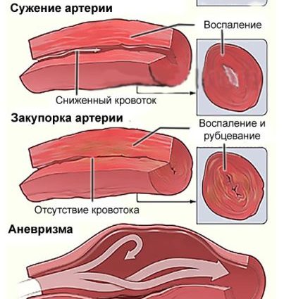 Vasculitis: causes, symptoms and treatment