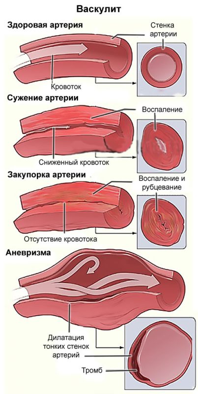 Vasculitis: causes, symptoms and treatment