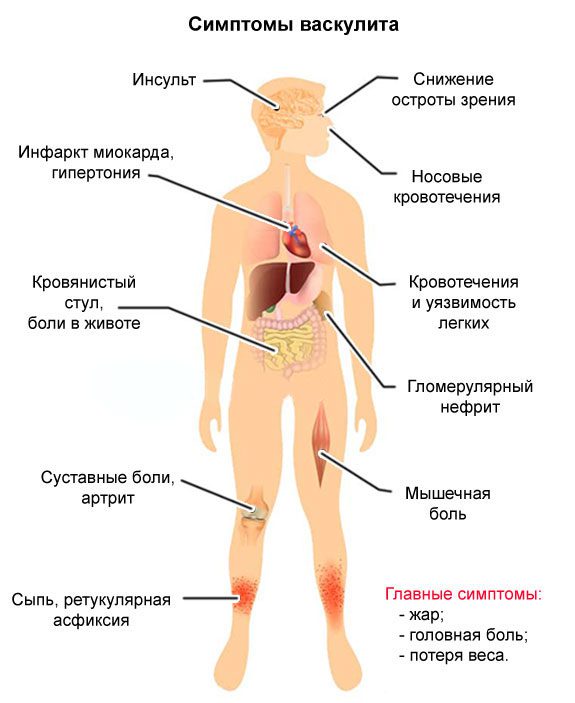 Vasculitis: causes, symptoms and treatment