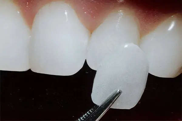 Veneers for teeth