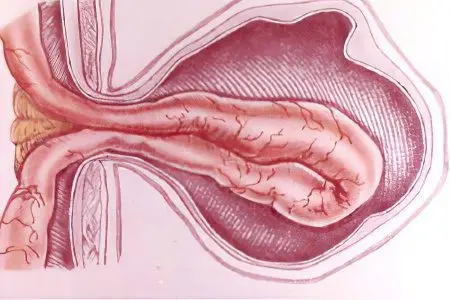 Ventral hernia (postoperative)