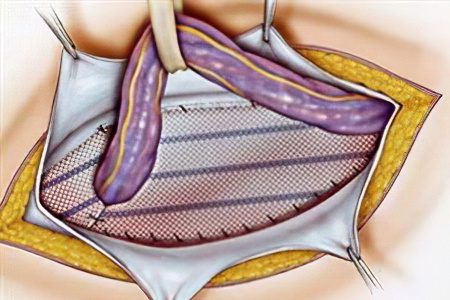 Ventral hernia (postoperative)