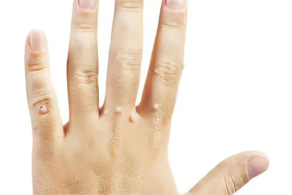 Warts on hands and fingers