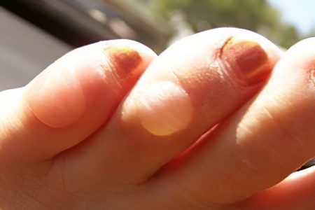 Water callus - how to quickly cure?