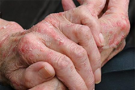 Weeping eczema on hands and feet