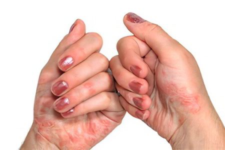 Weeping eczema on hands and feet