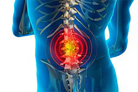 What can and cannot be done with an intervertebral hernia?