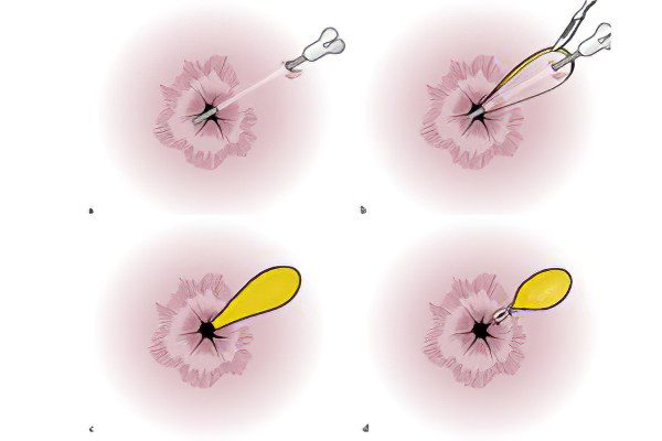 What is a fistula? Symptoms and treatment