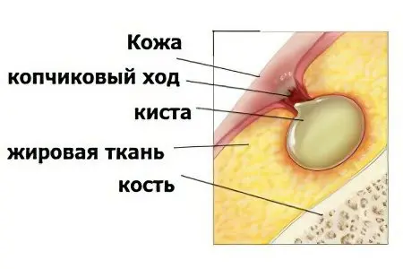 What is a fistula? Symptoms and treatment