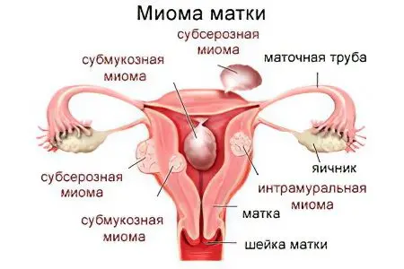 What is dangerous and how to treat uterine fibroids? Causes and symptoms