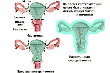 What is dangerous and how to treat uterine fibroids? Causes and symptoms