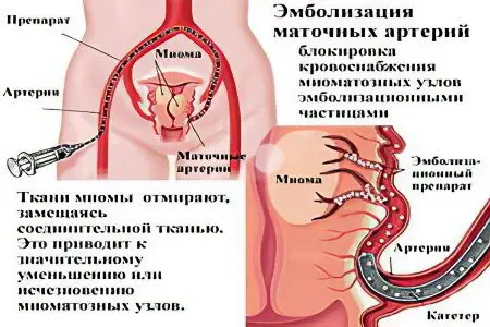 What is dangerous and how to treat uterine fibroids? Causes and symptoms