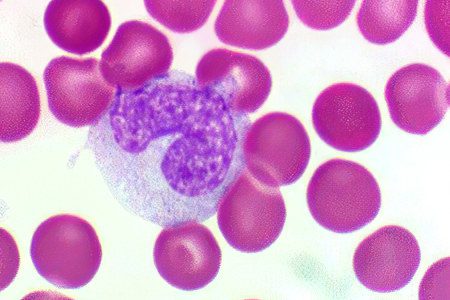 What to do if monocytes are elevated? Causes and consequences