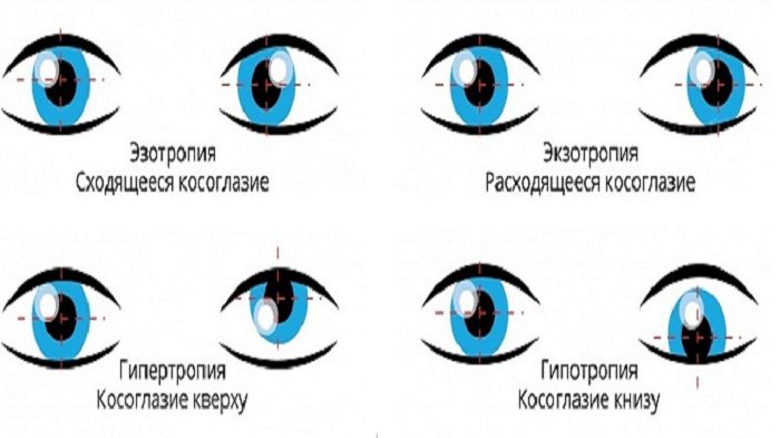 What to do if you suspect strabismus?