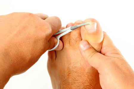 What to do with an ingrown toenail at home?