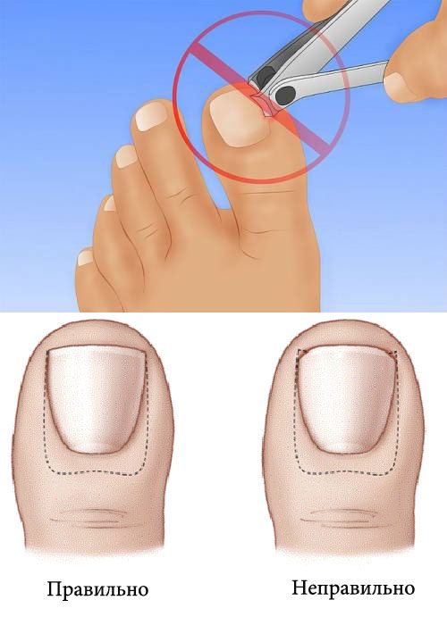 What to do with an ingrown toenail at home?