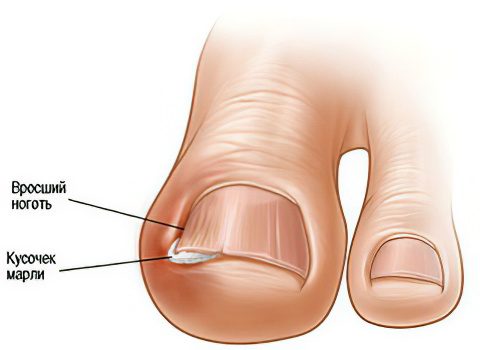 What to do with an ingrown toenail at home?