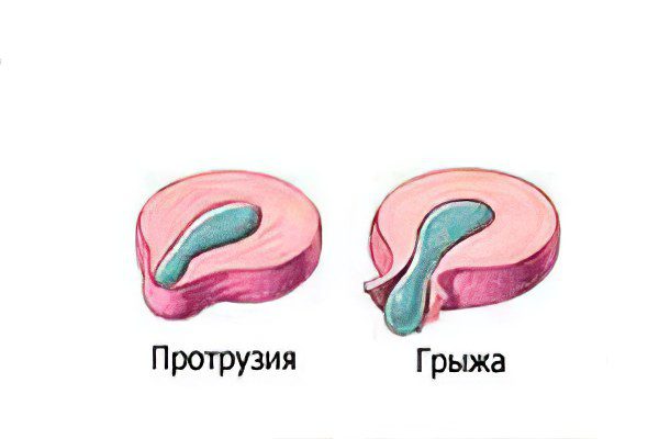 What to do with protrusion of discs l5 s1 and l4 l5?