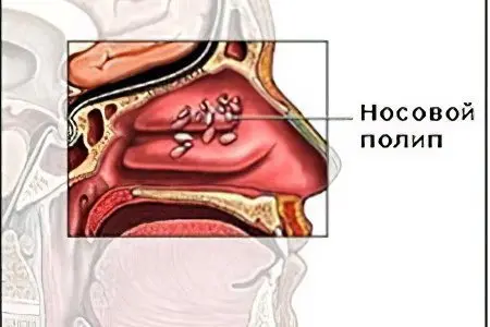 Why are nasal polyps dangerous? Symptoms, treatment and removal