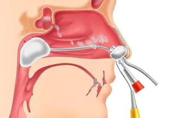 Why are nasal polyps dangerous? Symptoms, treatment and removal