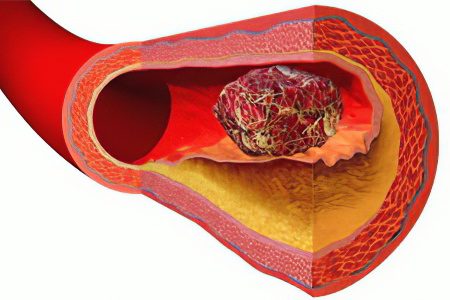 Why did a blood clot come off and what to do?