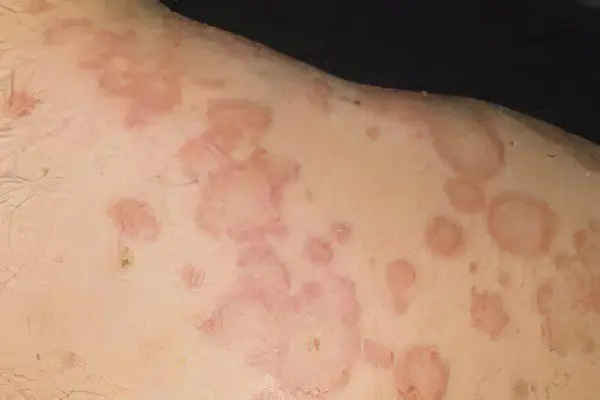 Why do red spots appear on the skin?