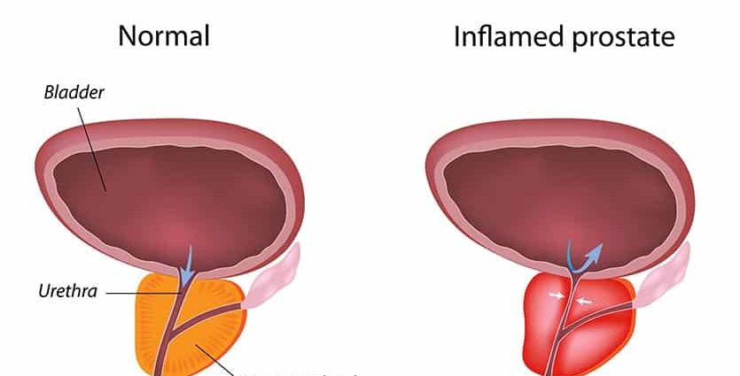 Why is prostatitis dangerous?