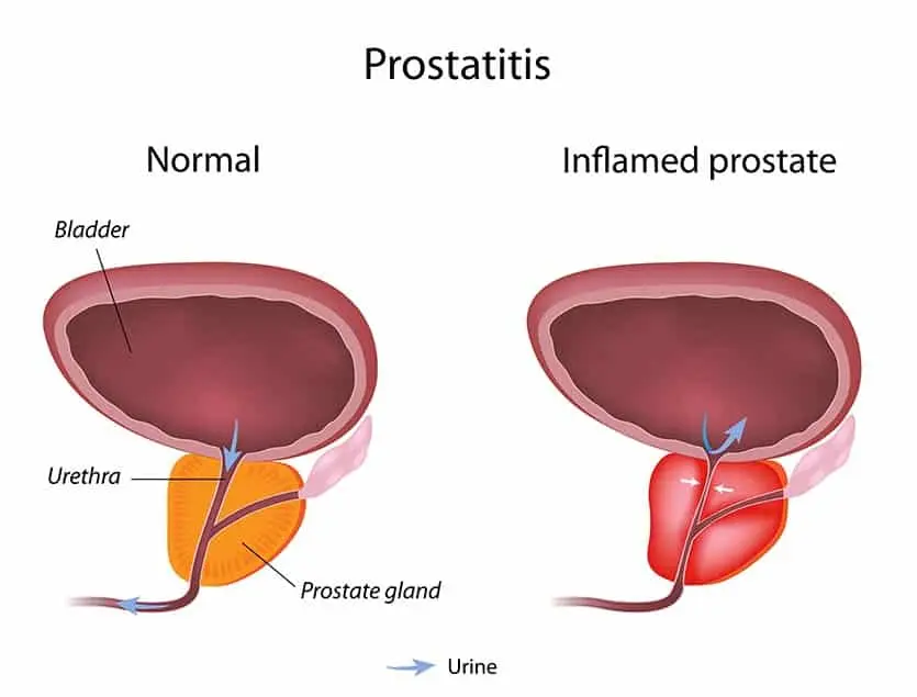 Why is prostatitis dangerous?