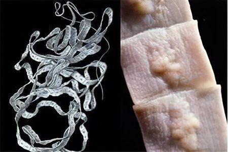 Wide tapeworm (diphyllobothriasis)