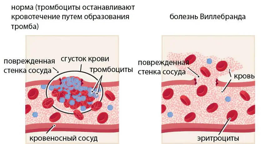 Willebrand disease: how to treat?