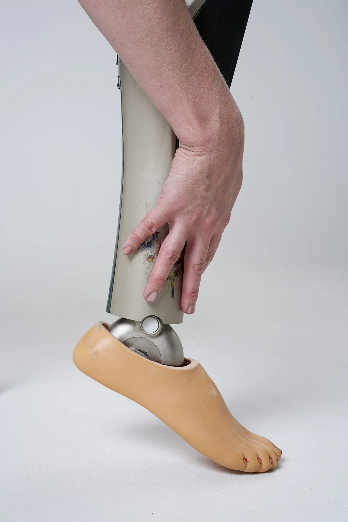 With an iron character: how people with bioprostheses live. Photo gallery