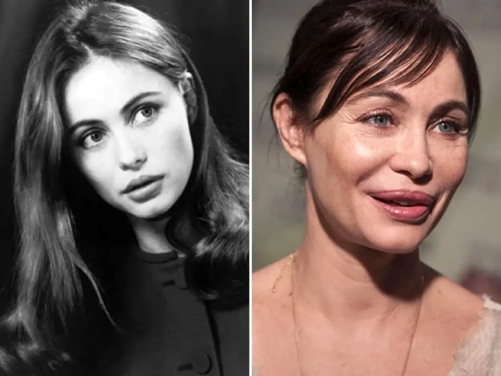 10 actresses whose career ended due to the fault of plastic surgeons