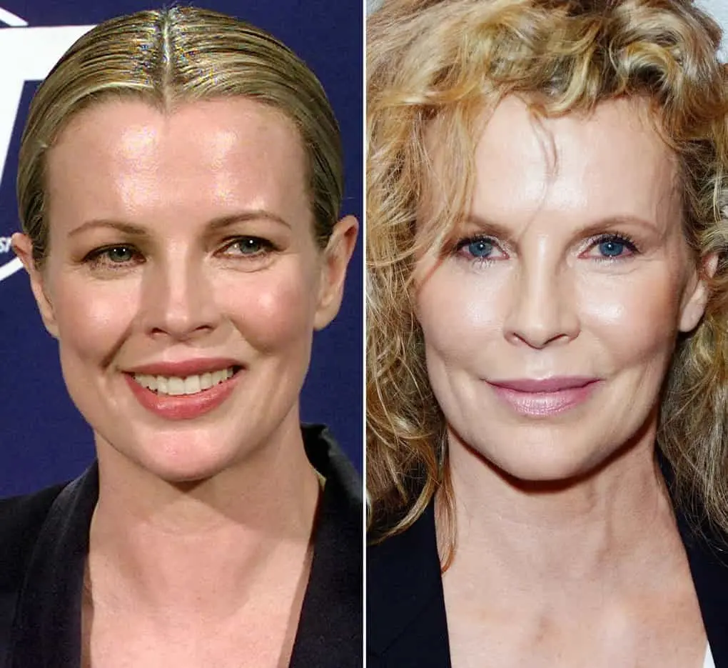 10 actresses whose career ended due to the fault of plastic surgeons