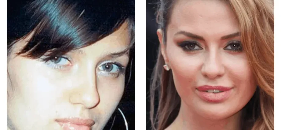 10 celebrities who have had blepharoplasty