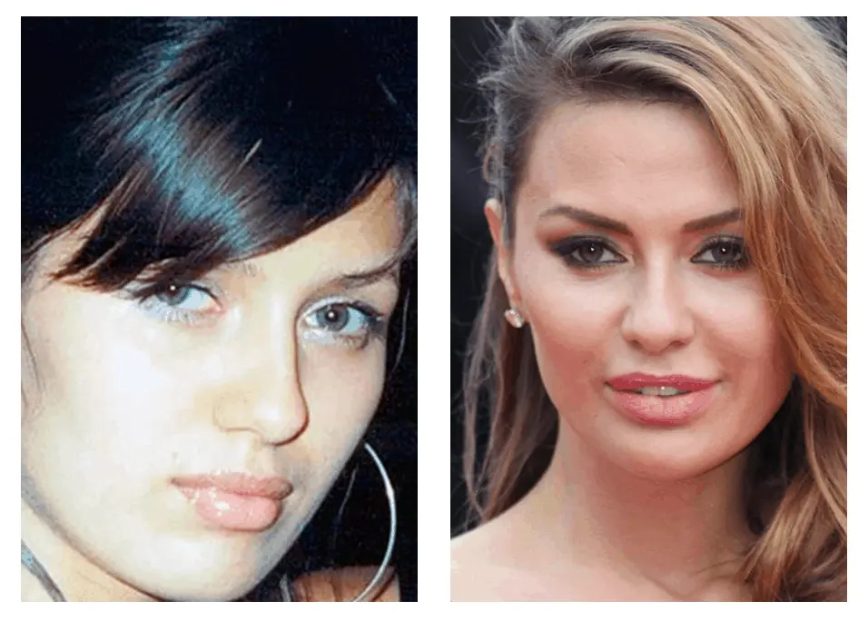 10 celebrities who have had blepharoplasty