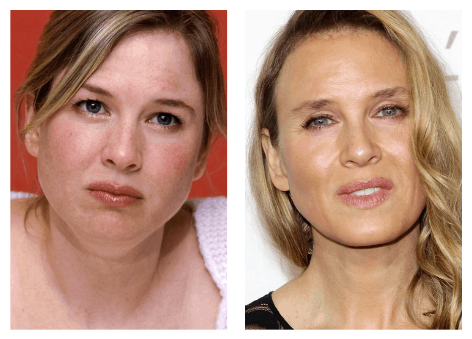 10 celebrities who have had blepharoplasty