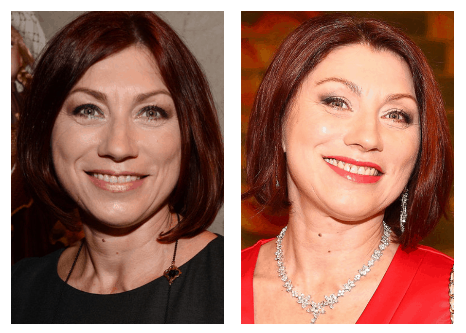 10 celebrities who have had blepharoplasty