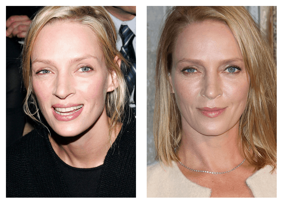 10 celebrities who have had blepharoplasty