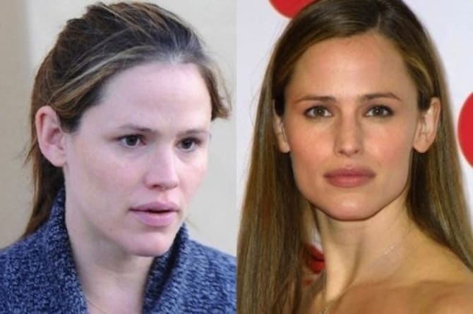 10 celebrities who have had otoplasty