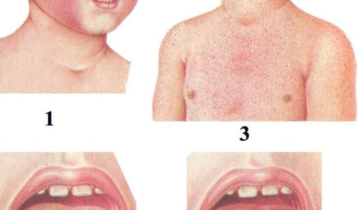 10 diseases of children that all parents should be able to distinguish