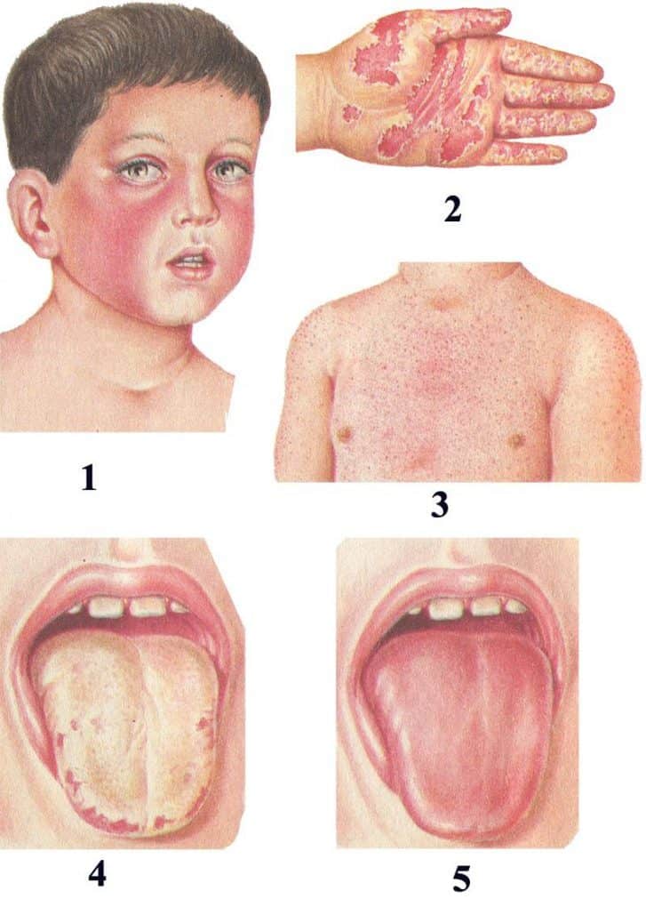 10 diseases of children that all parents should be able to distinguish