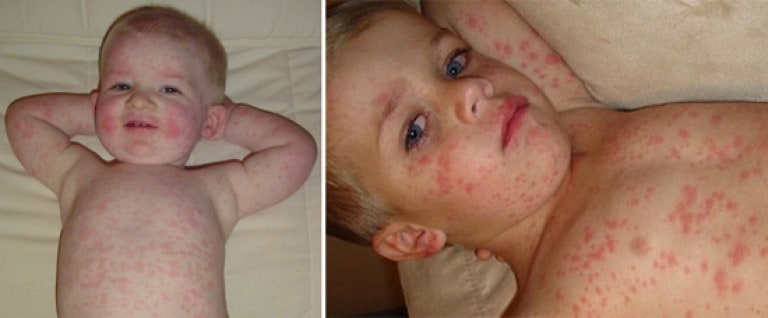 10 diseases of children that all parents should be able to distinguish