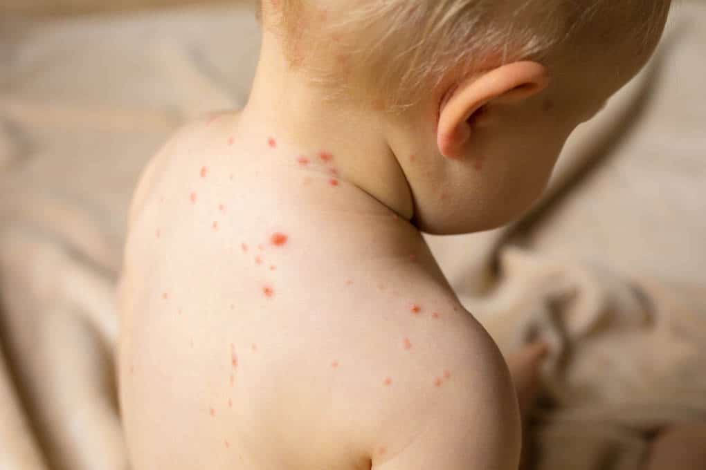 10 diseases of children that all parents should be able to distinguish