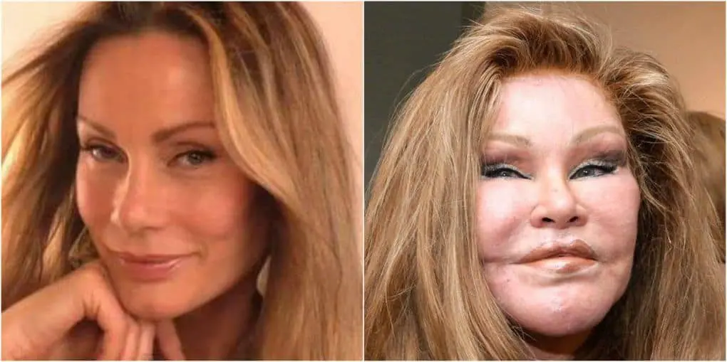 10 former beauties who mutilated themselves with plastic surgery